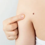 皮膚がんのセルフチェック方法は？病気の種類や症状を解説