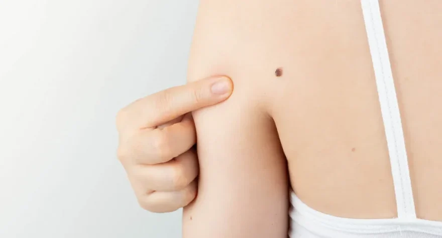 皮膚がんのセルフチェック方法は？病気の種類や症状を解説 | がんメディ