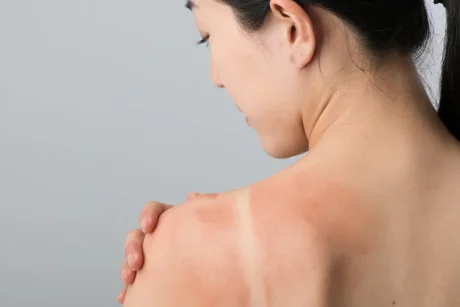 日焼けをすると皮膚がんになる？紫外線から身を守る方法を解説