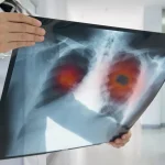 肺がんで手術できないと言われたら余命はどのくらい?他の治療方法も解説