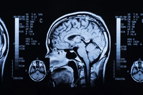 小児脳幹部グリオーマとは？原因・症状・治療と生存率